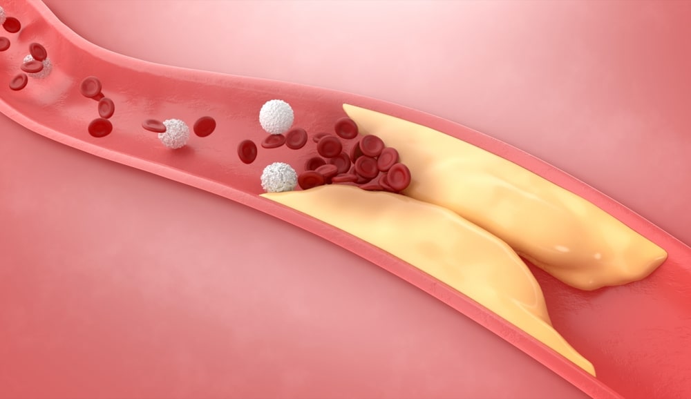Is Your Risk of Thrombosis Written in Your DNA?